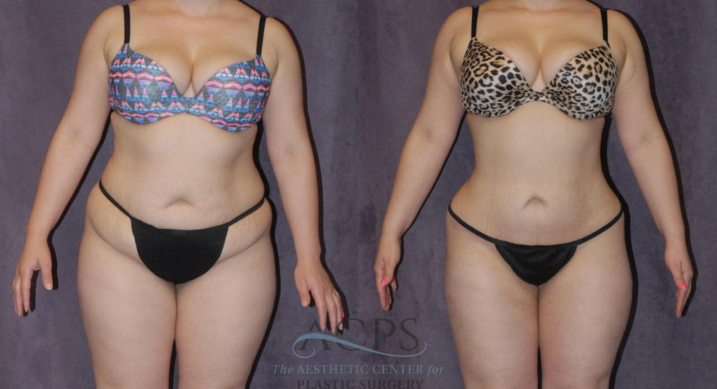 Before & After Liposuction Case 225 Front View: View in Houston, TX