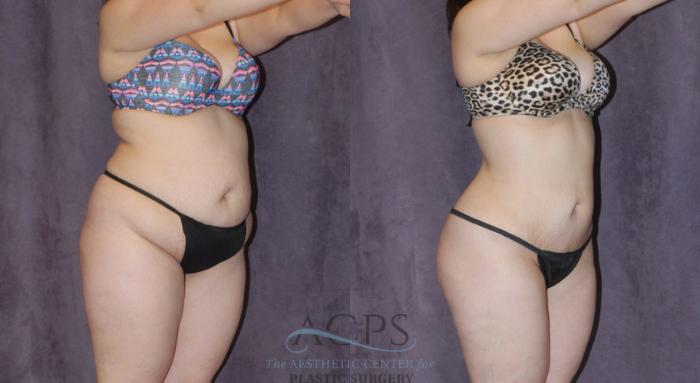 Before & After Liposuction Case 225 Oblique View: View in Houston, TX