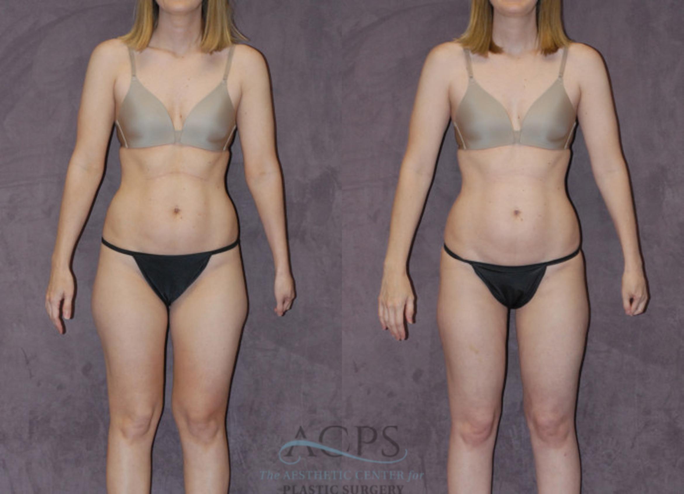 Before & After Liposuction Case 235 Front View: View in Houston, TX