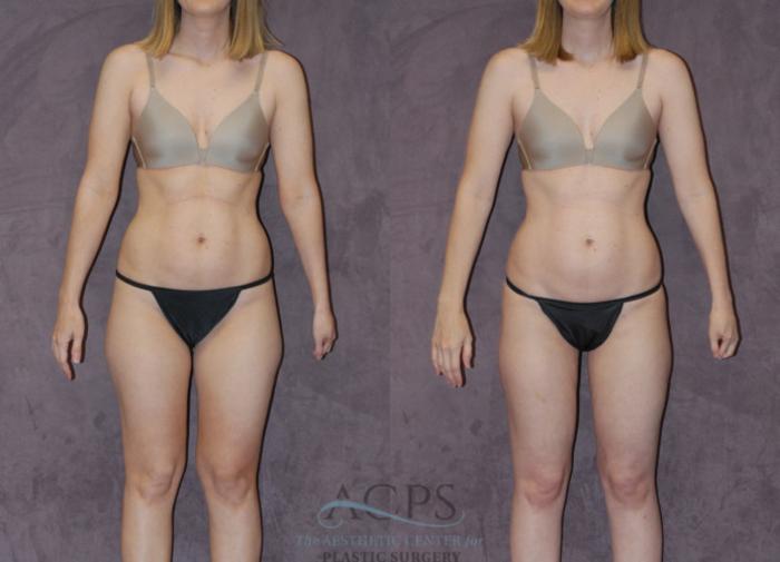 Before & After Liposuction Case 235 Front View: View in Houston, TX