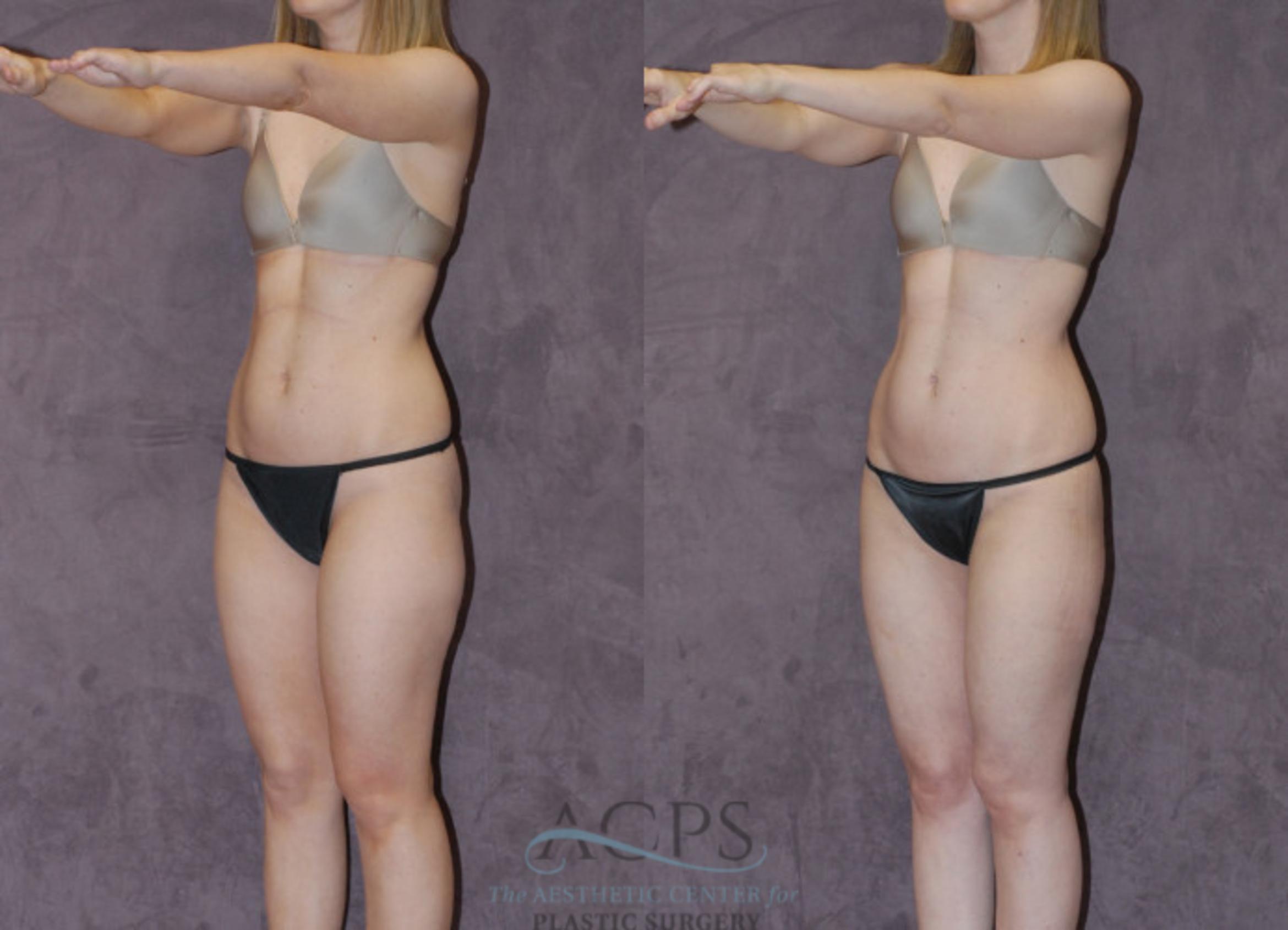 Before & After Liposuction Case 235 Oblique View: View in Houston, TX