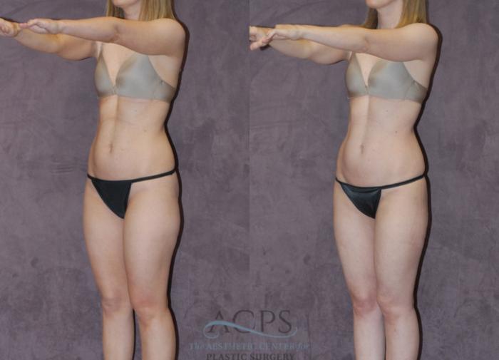 Before & After Liposuction Case 235 Oblique View: View in Houston, TX