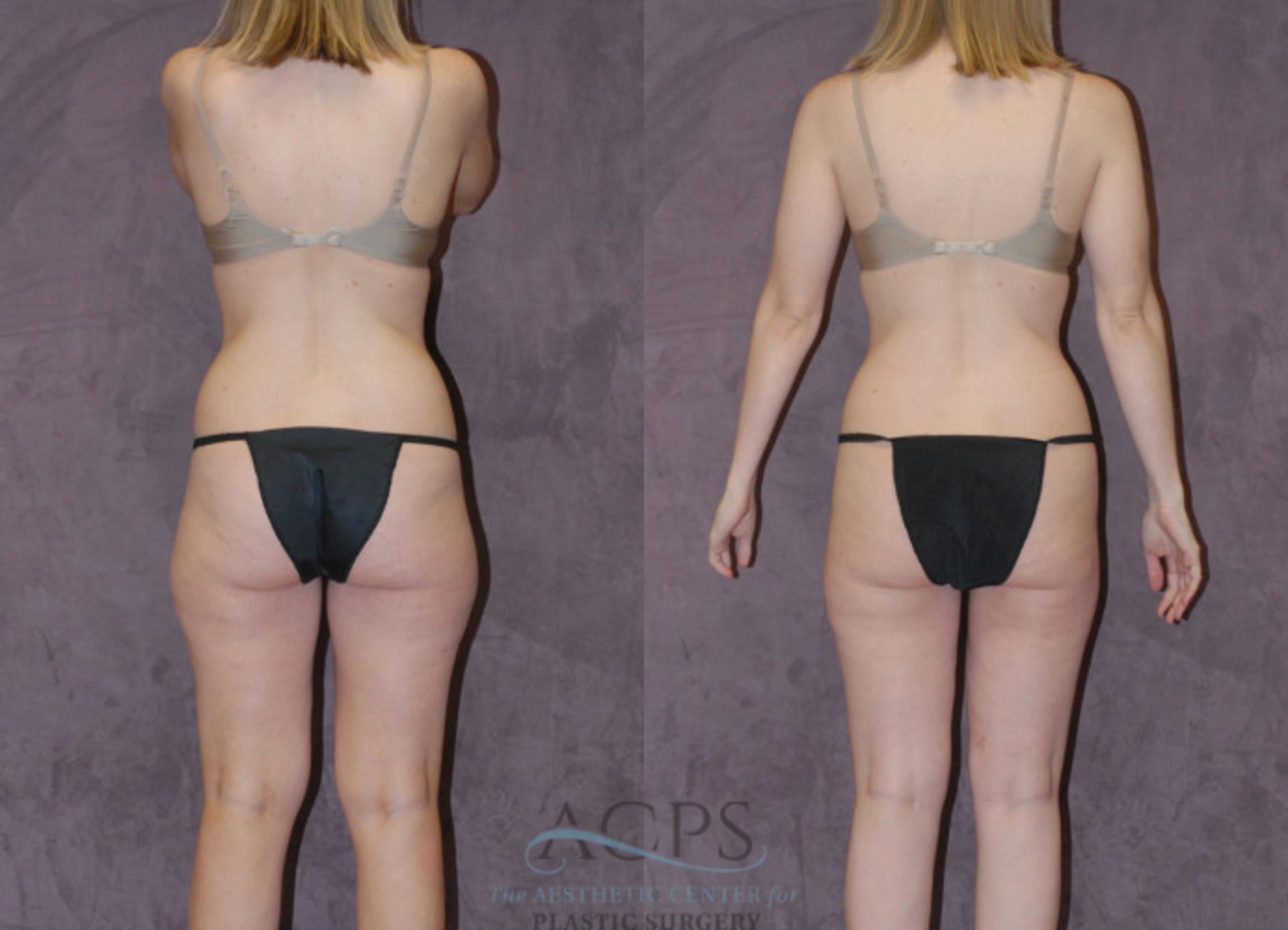 Before & After Liposuction Case 235 Rear View: View in Houston, TX