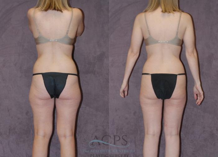 Before & After Liposuction Case 235 Rear View: View in Houston, TX