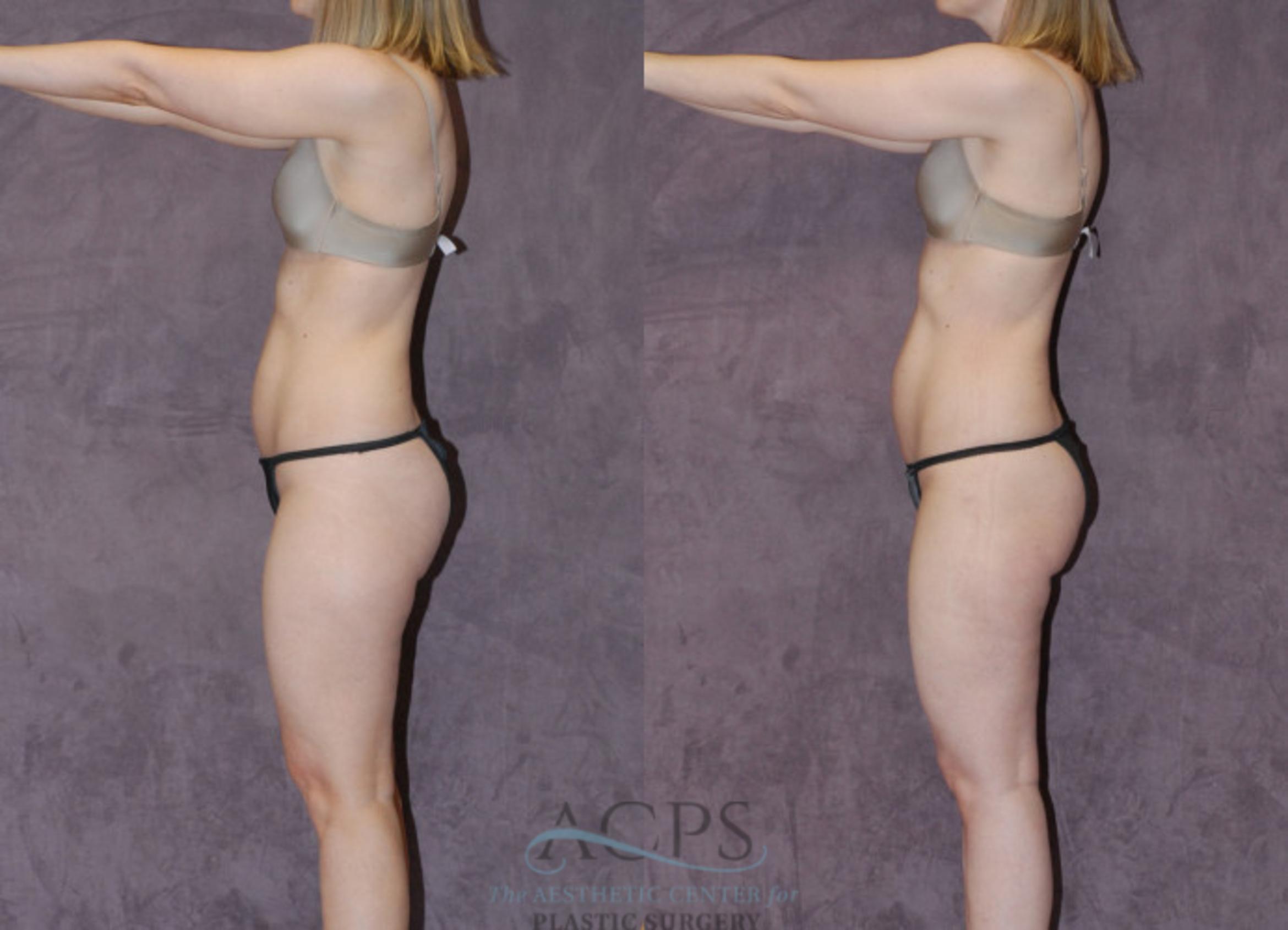 Before & After Liposuction Case 235 Side View: View in Houston, TX