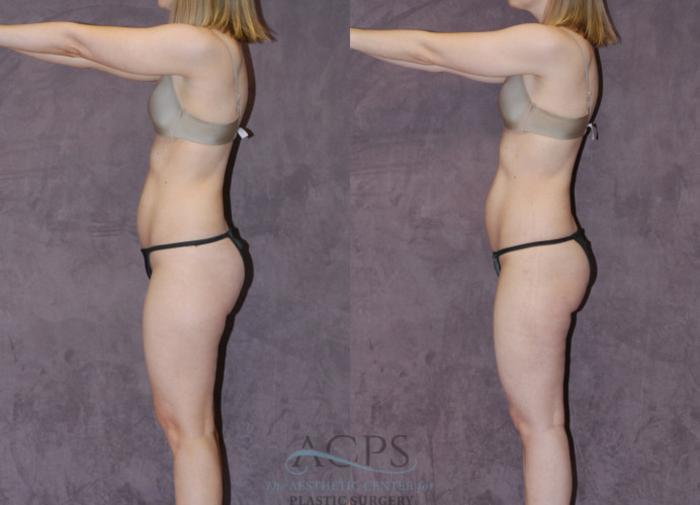 Before & After Liposuction Case 235 Side View: View in Houston, TX