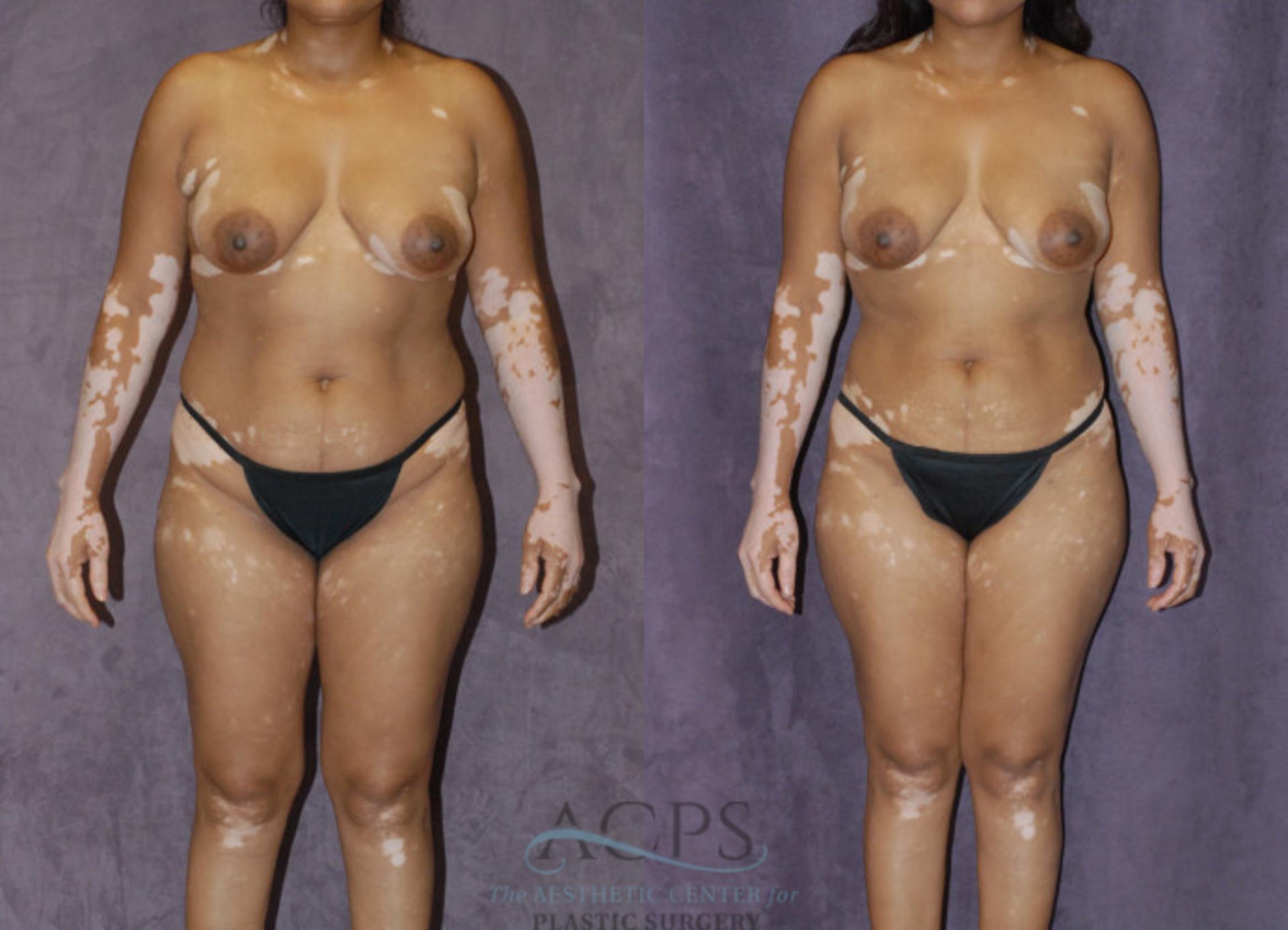 Before & After Liposuction Case 236 Front View: View in Houston, TX