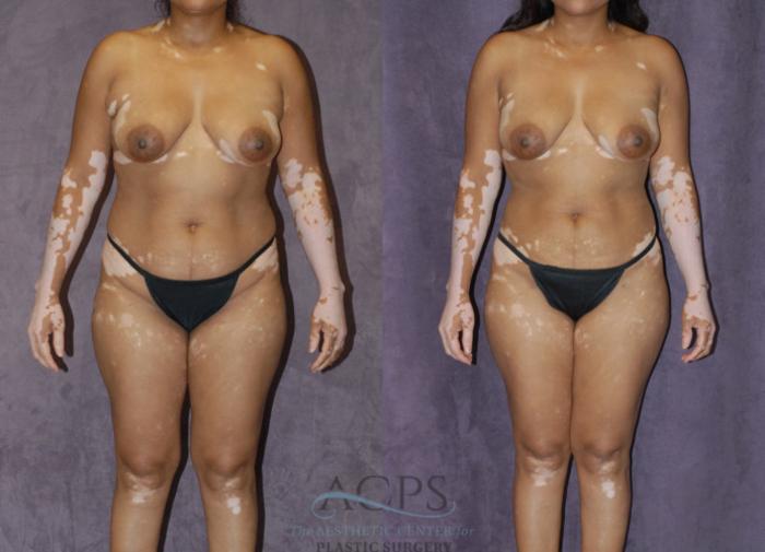 Before & After Liposuction Case 236 Front View: View in Houston, TX