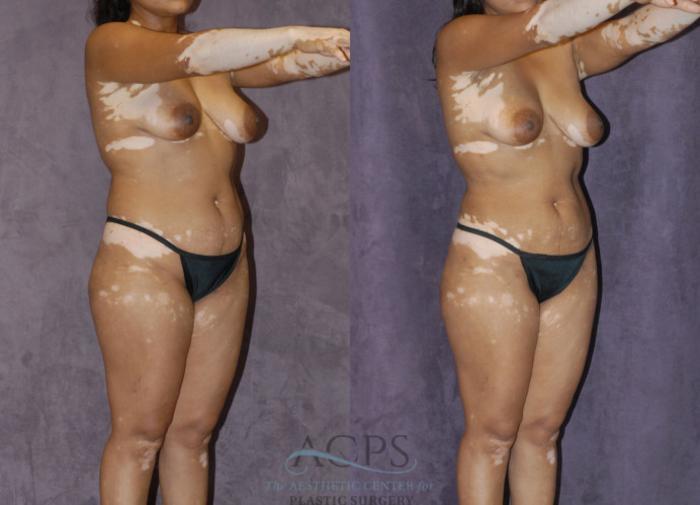 Before & After Liposuction Case 236 Oblique View: View in Houston, TX