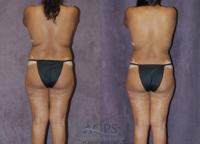Before & After Liposuction Case 236 Rear View: View in Houston, TX