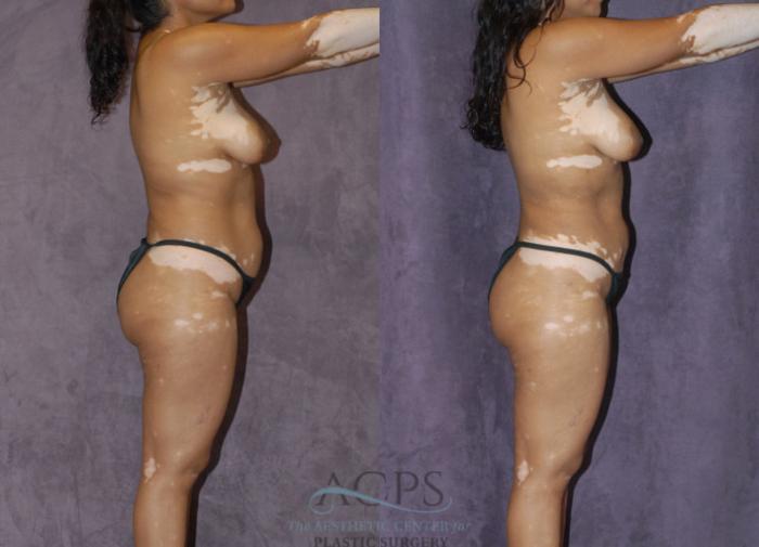 Before & After Liposuction Case 236 Side View: View in Houston, TX