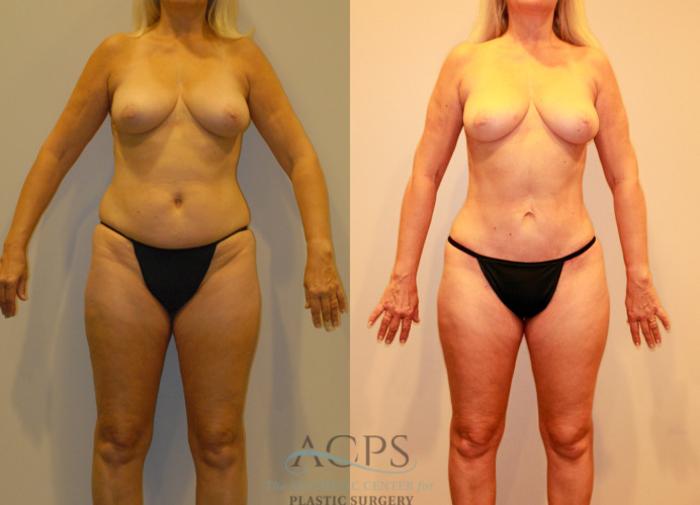 Before & After Liposuction Case 237 Front View: View in Houston, TX