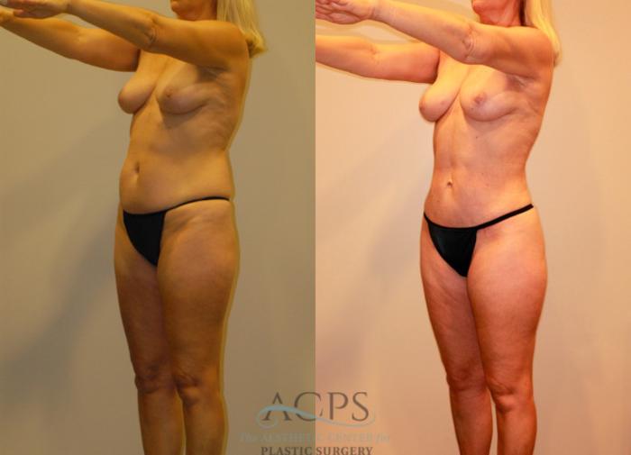 Before & After Liposuction Case 237 Oblique View: View in Houston, TX