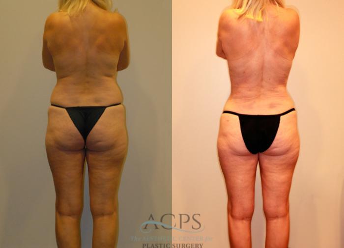 Before & After Liposuction Case 237 Rear View: View in Houston, TX