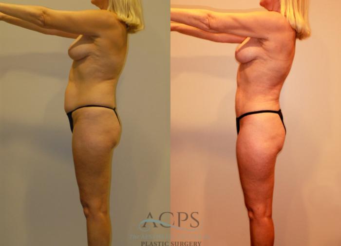 Before & After Liposuction Case 237 Side View: View in Houston, TX