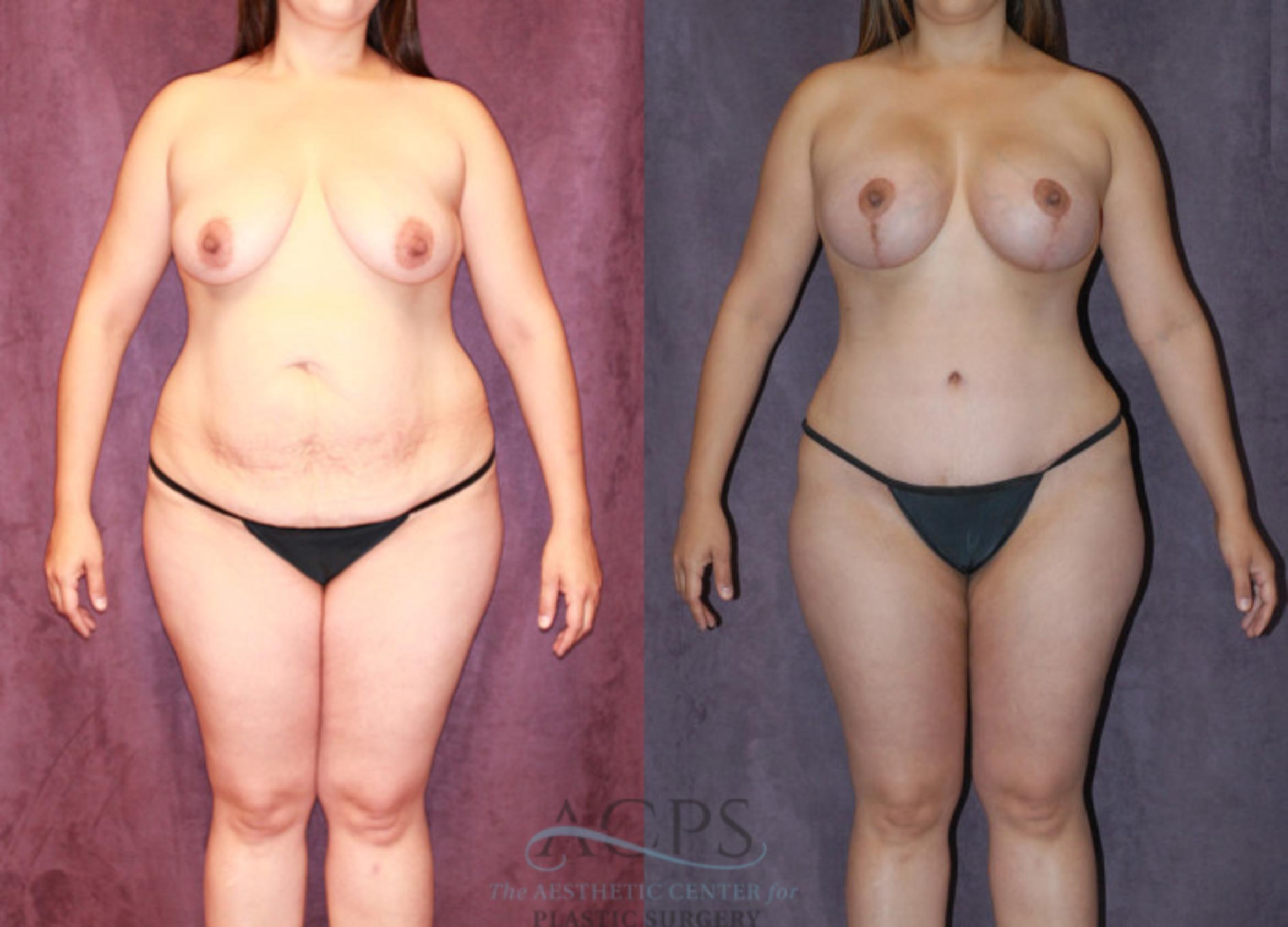 Before & After Liposuction Case 238 Front View: View in Houston, TX