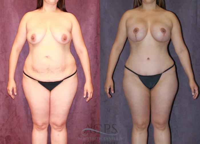 Before & After Liposuction Case 238 Front View: View in Houston, TX