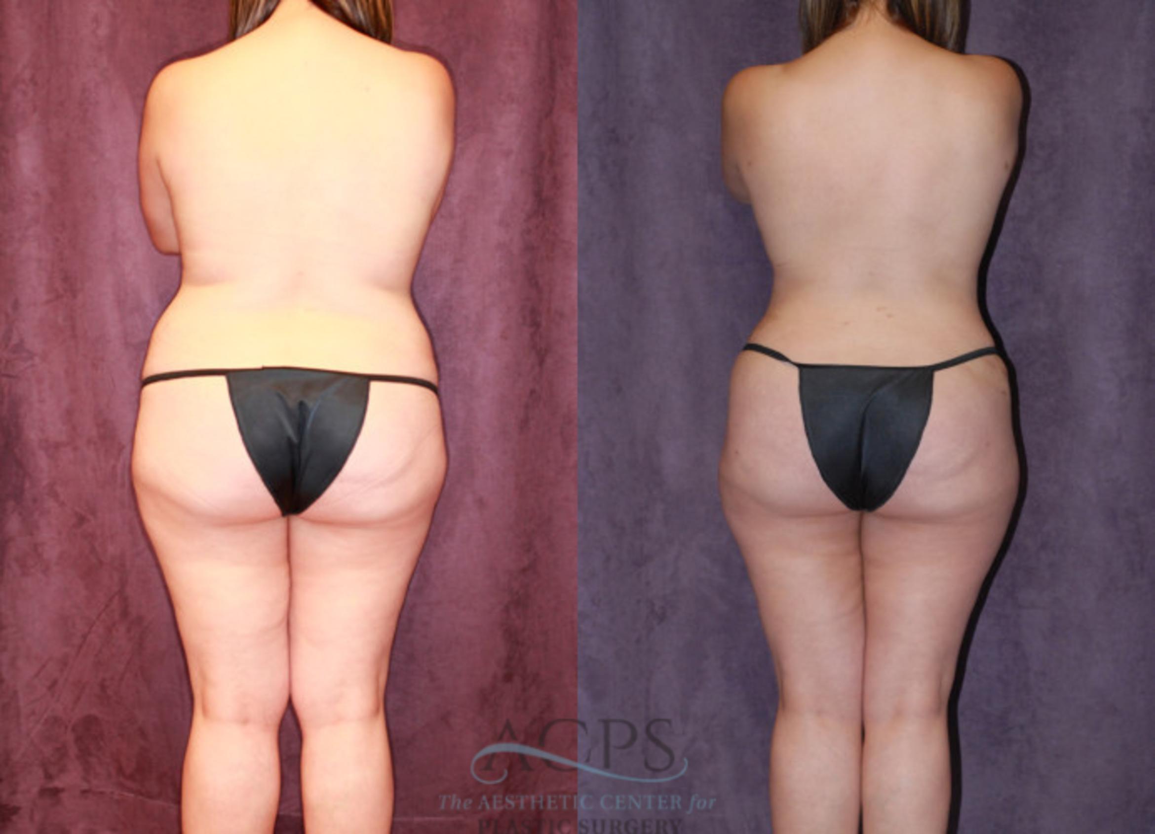 Before & After Liposuction Case 238 Rear View: View in Houston, TX