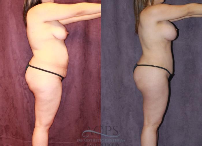 Before & After Liposuction Case 238 Side View: View in Houston, TX