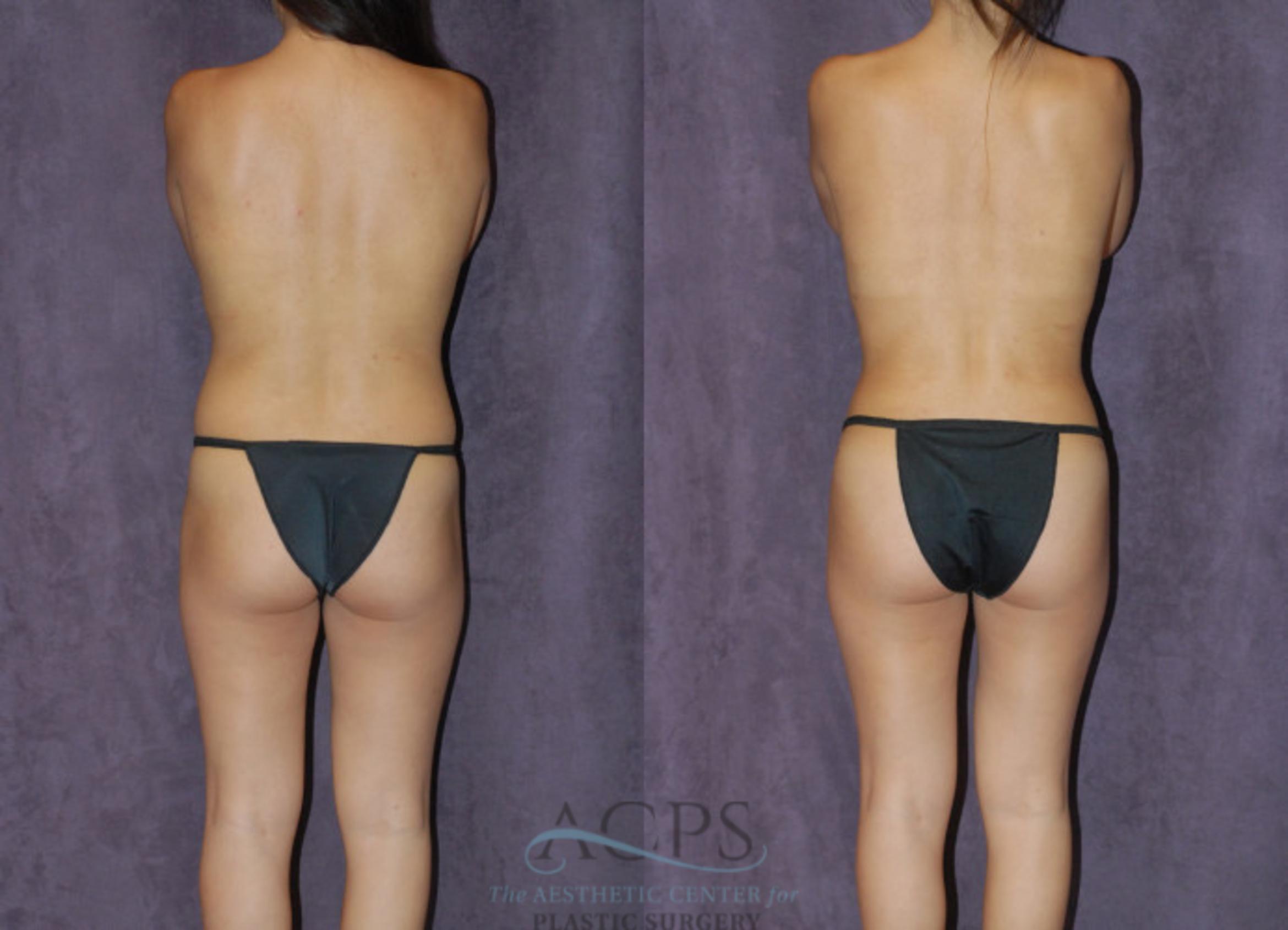 Before & After Liposuction Case 239 Rear View: View in Houston, TX