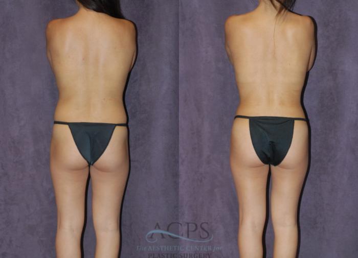 Before & After Liposuction Case 239 Rear View: View in Houston, TX