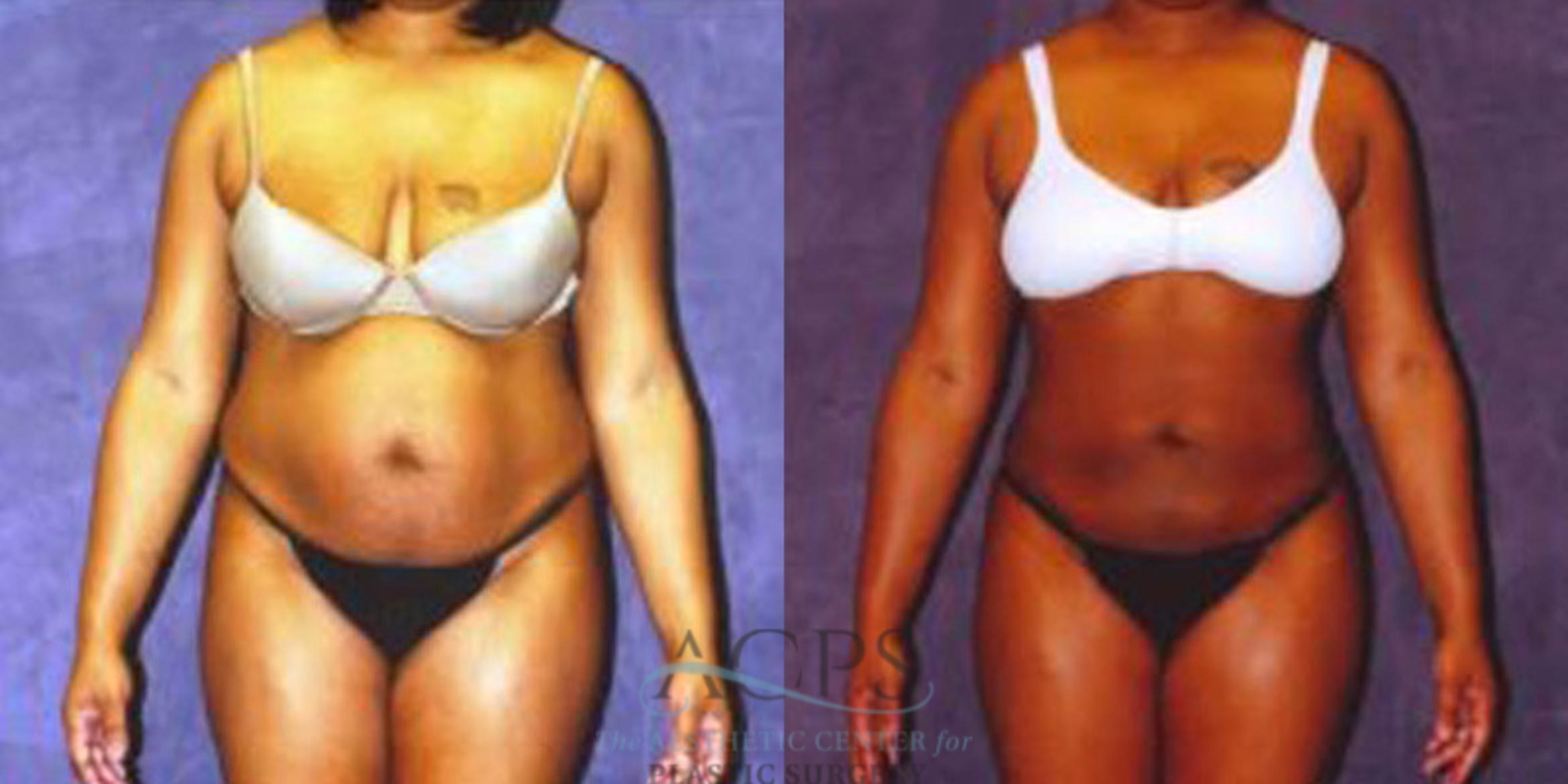 Before & After Liposuction Case 240 Front View: View in Houston, TX