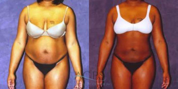 Before & After Liposuction Case 240 Front View: View in Houston, TX