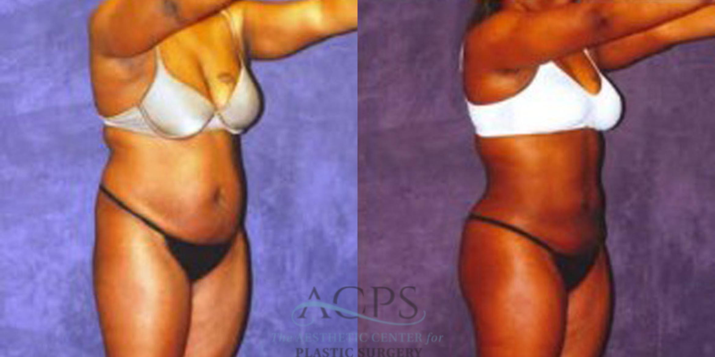 Before & After Liposuction Case 240 Oblique View: View in Houston, TX