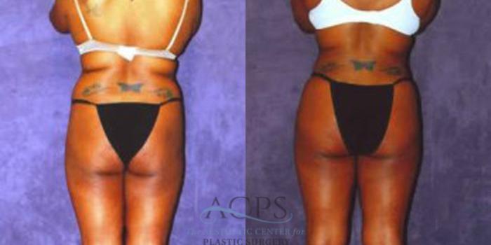 Before & After Liposuction Case 240 Rear View: View in Houston, TX