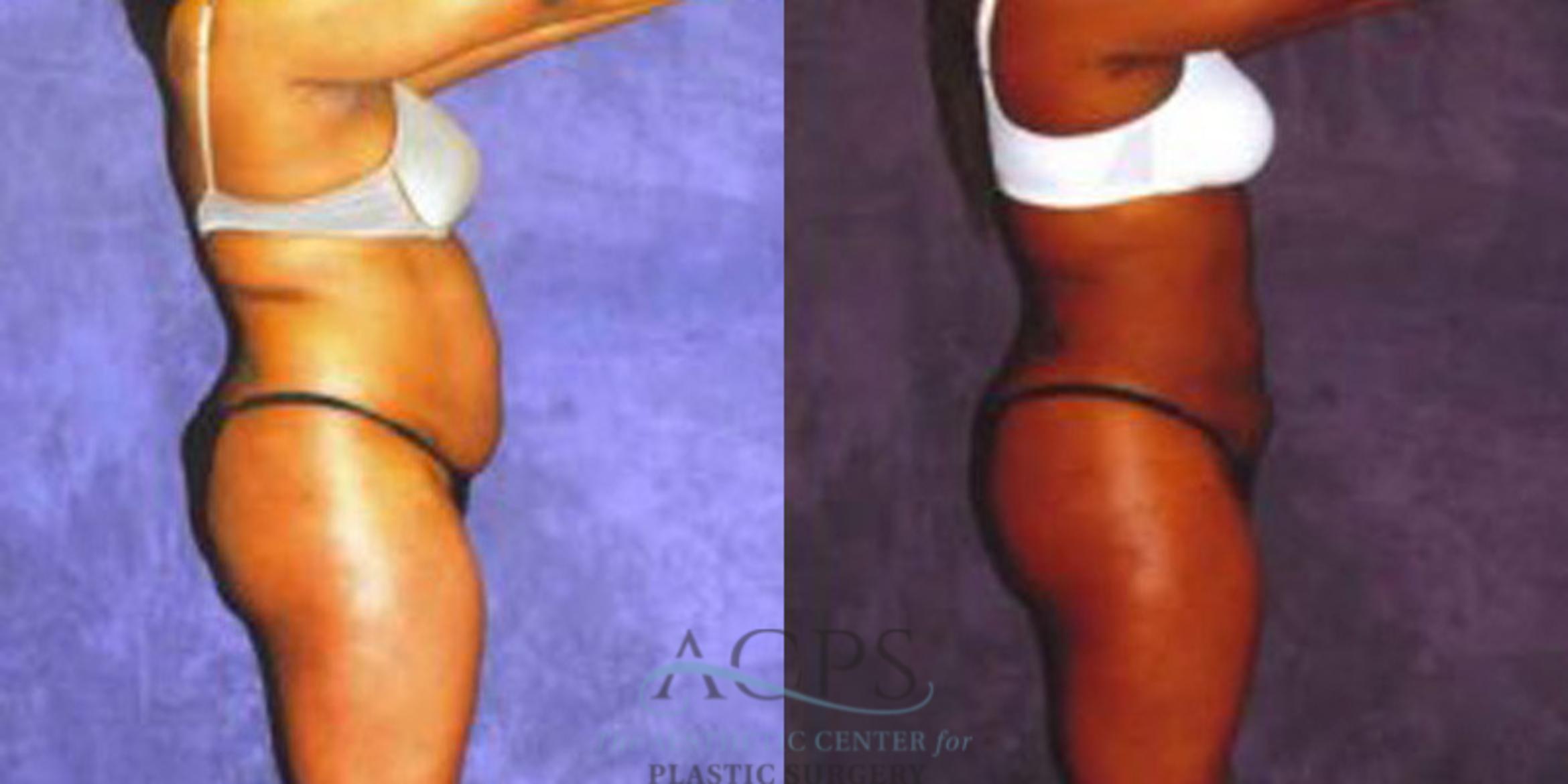Before & After Liposuction Case 240 Side View: View in Houston, TX