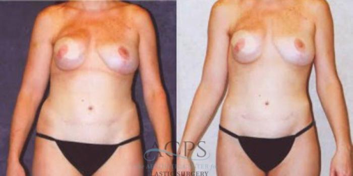 Before & After Liposuction Case 241 Front View: View in Houston, TX