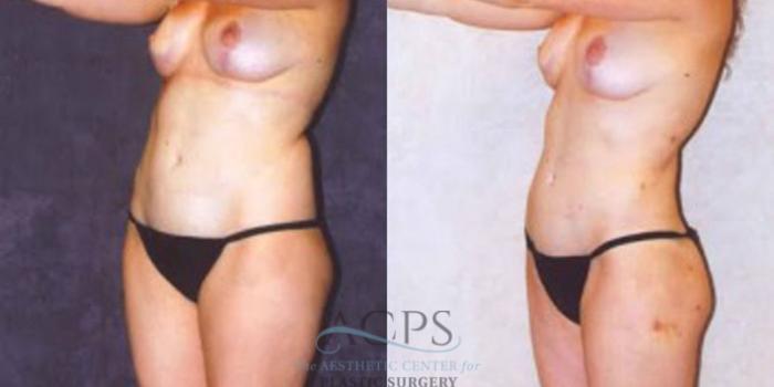 Before & After Liposuction Case 241 Oblique View: View in Houston, TX