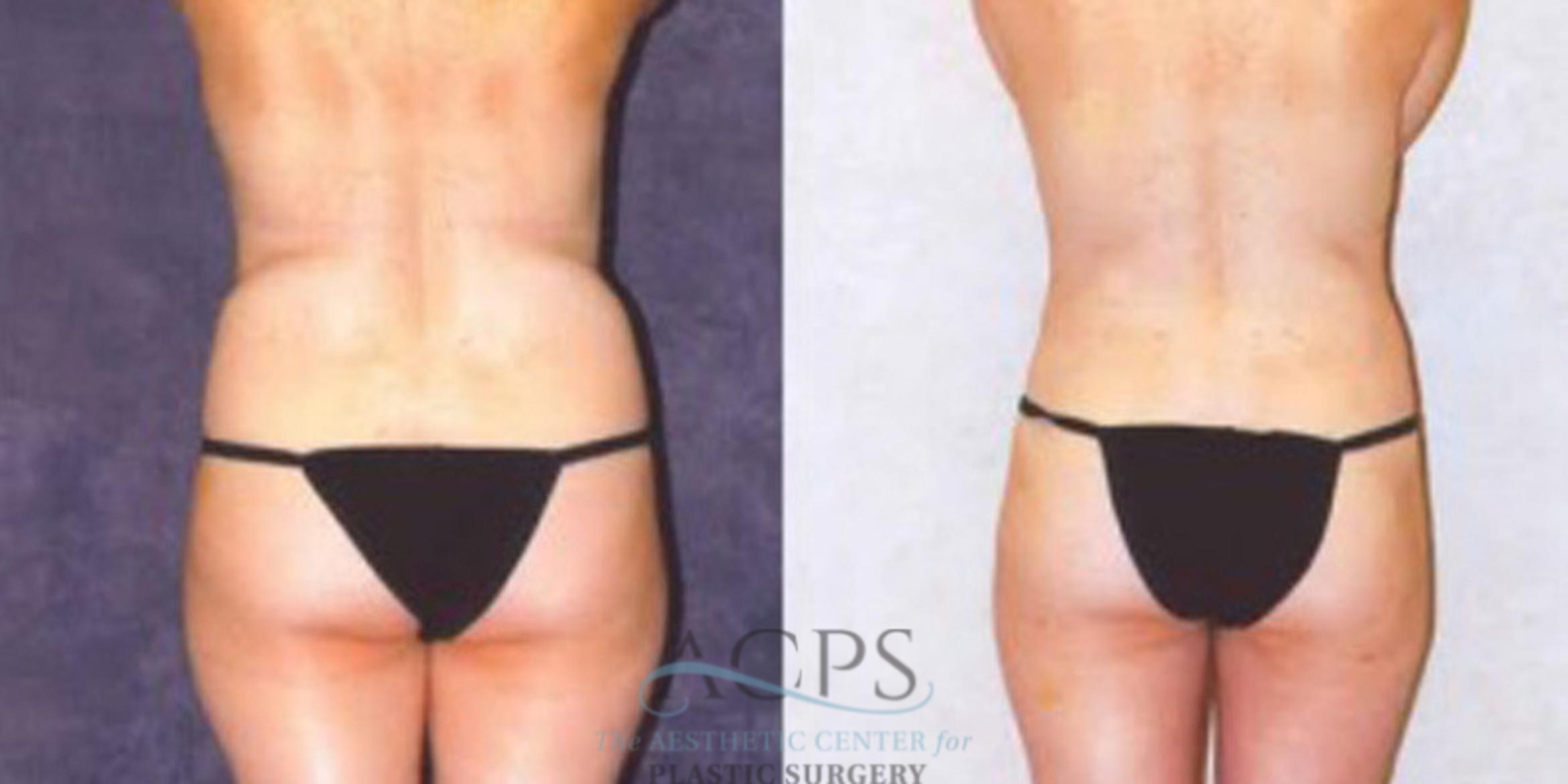 Before & After Liposuction Case 241 Rear View: View in Houston, TX