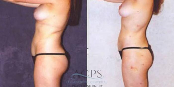 Before & After Liposuction Case 241 Side View: View in Houston, TX