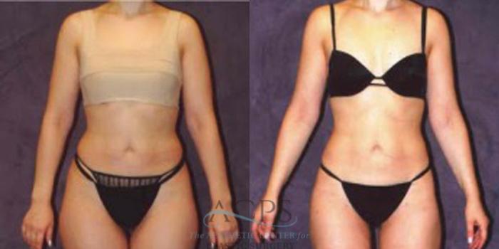 Before & After Liposuction Case 242 Front View: View in Houston, TX