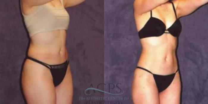 Before & After Liposuction Case 242 Oblique View: View in Houston, TX