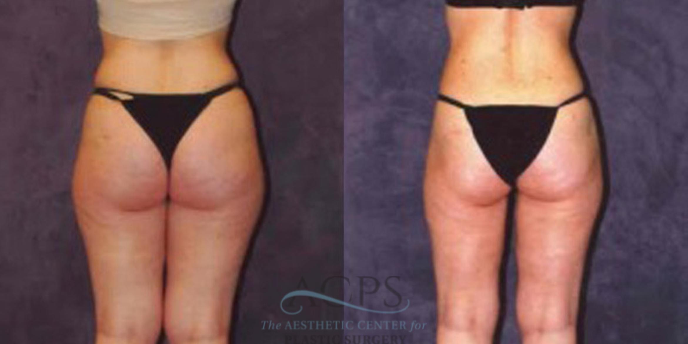 Before & After Liposuction Case 242 Rear View: View in Houston, TX
