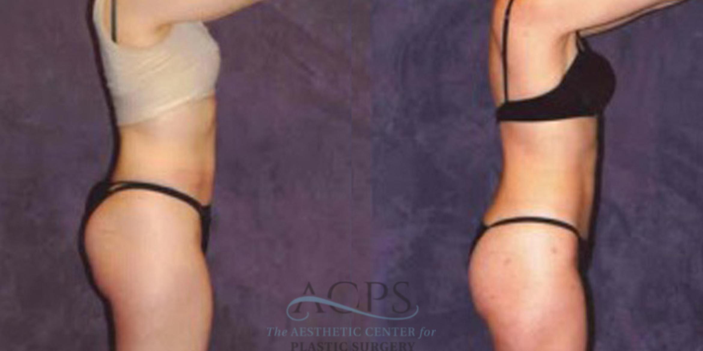 Before & After Liposuction Case 242 Side View: View in Houston, TX