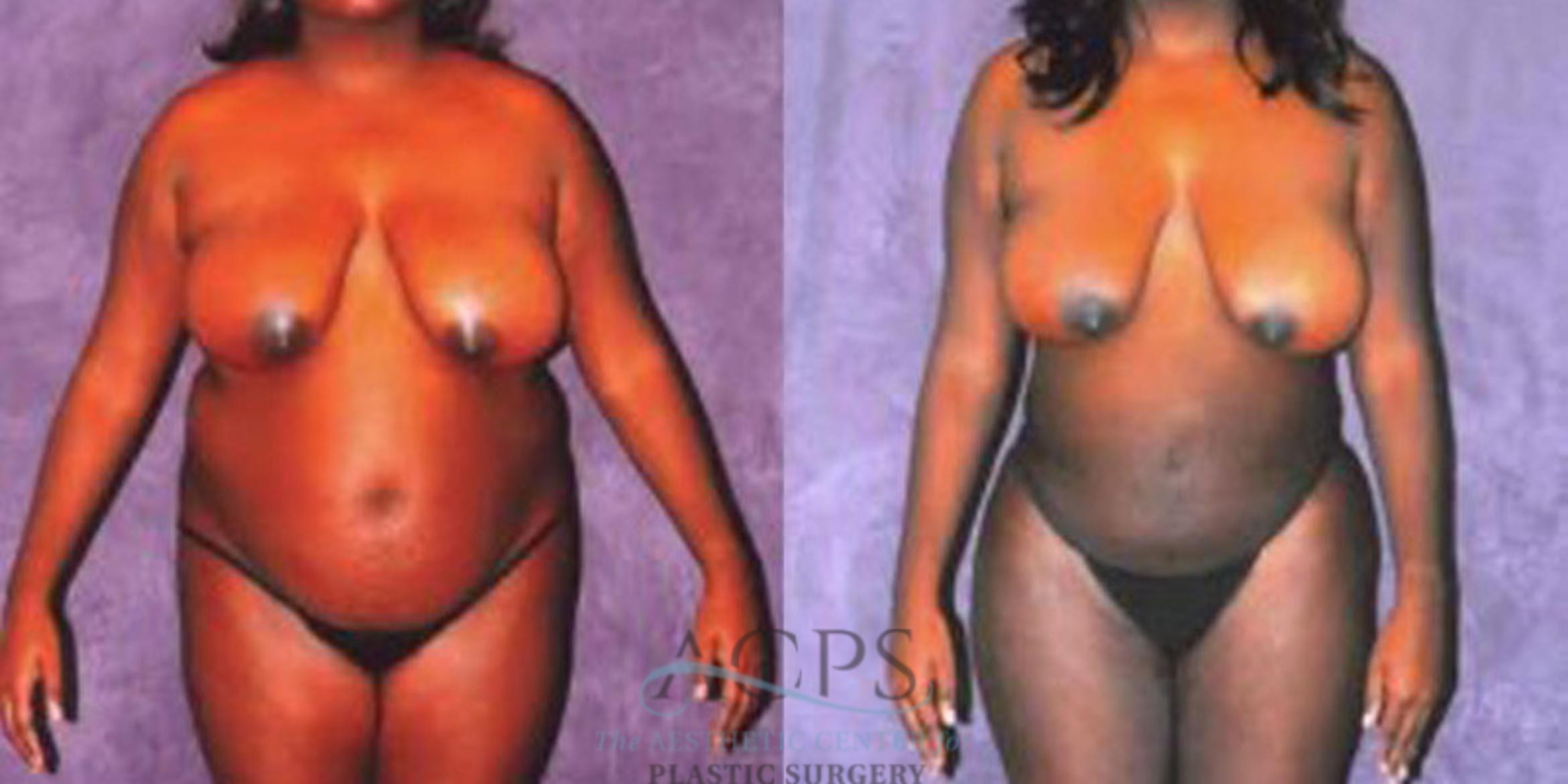 Before & After Liposuction Case 243 Front View: View in Houston, TX