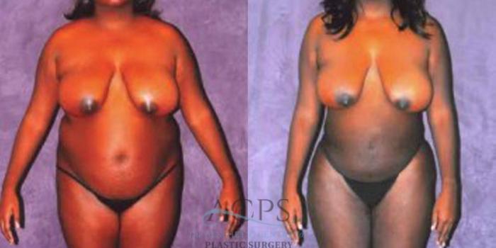 Before & After Liposuction Case 243 Front View: View in Houston, TX