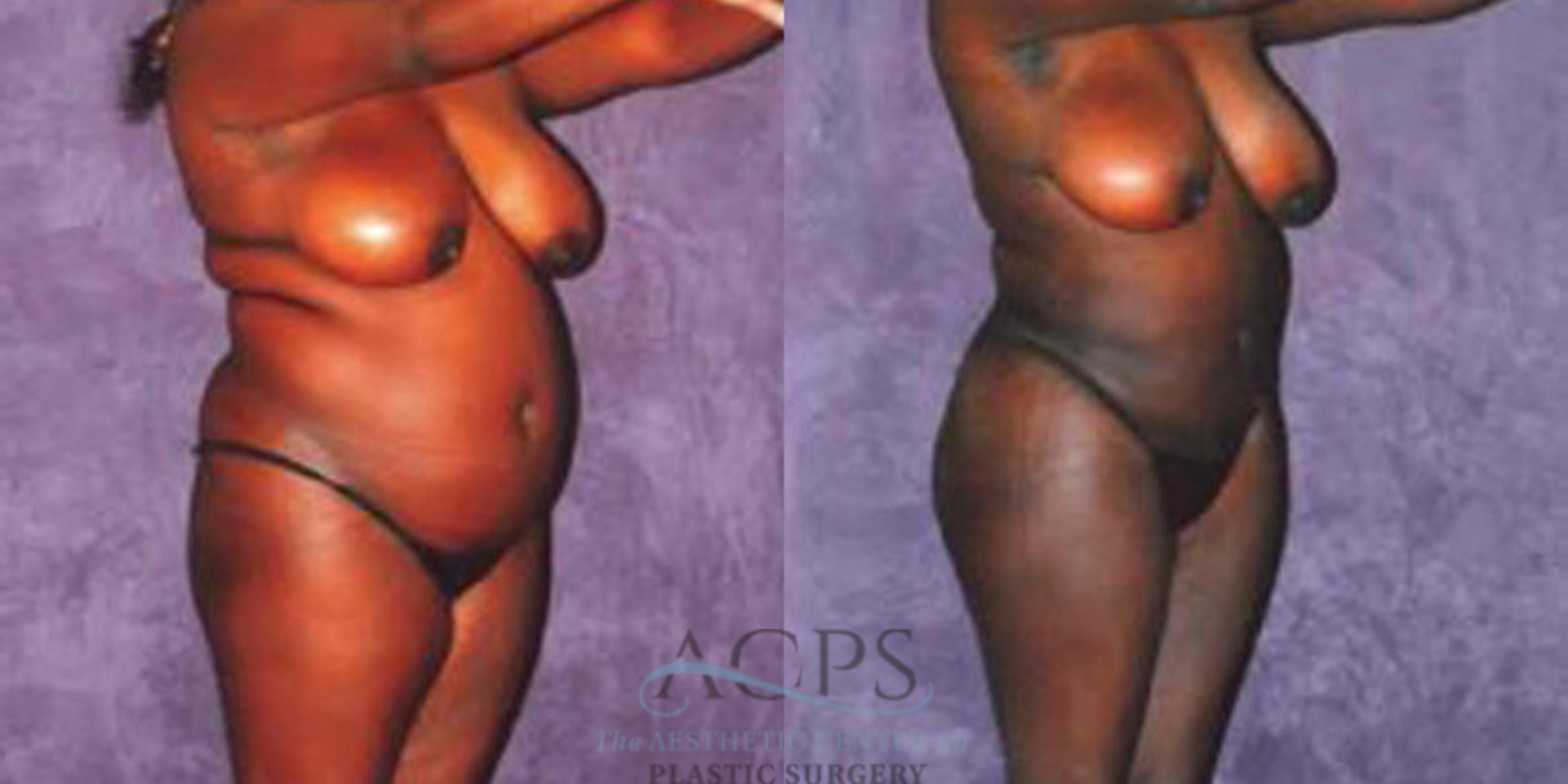 Before & After Liposuction Case 243 Oblique View: View in Houston, TX