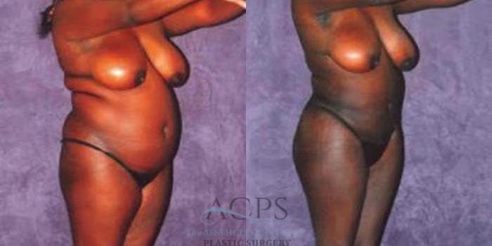 Before & After Liposuction Case 243 Oblique View: View in Houston, TX