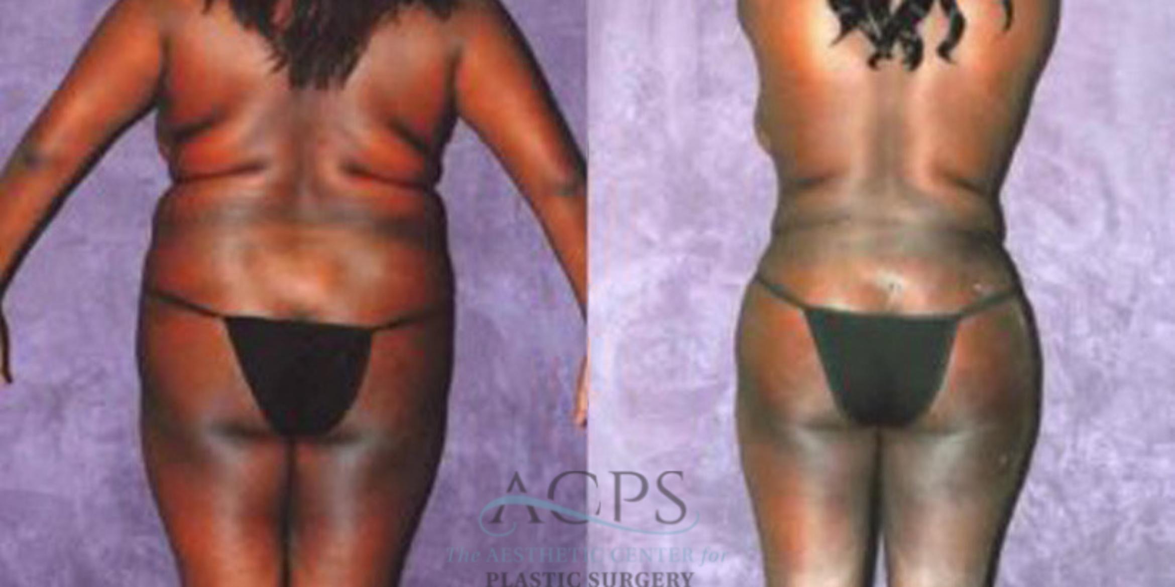 Before & After Liposuction Case 243 Rear View: View in Houston, TX