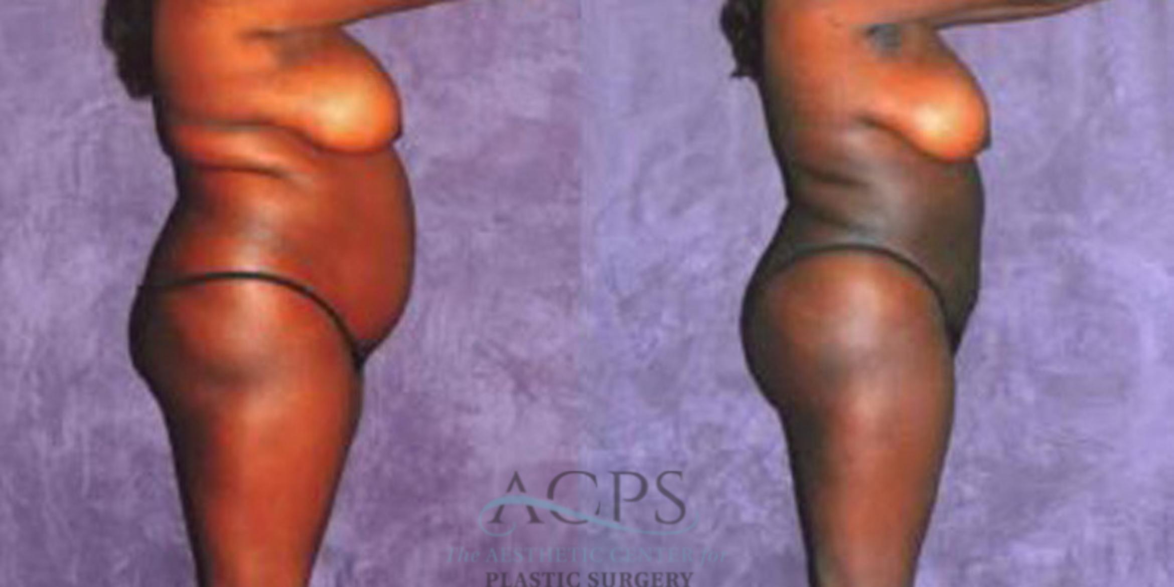 Before & After Liposuction Case 243 Side View: View in Houston, TX