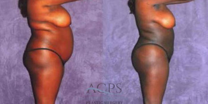 Before & After Liposuction Case 243 Side View: View in Houston, TX