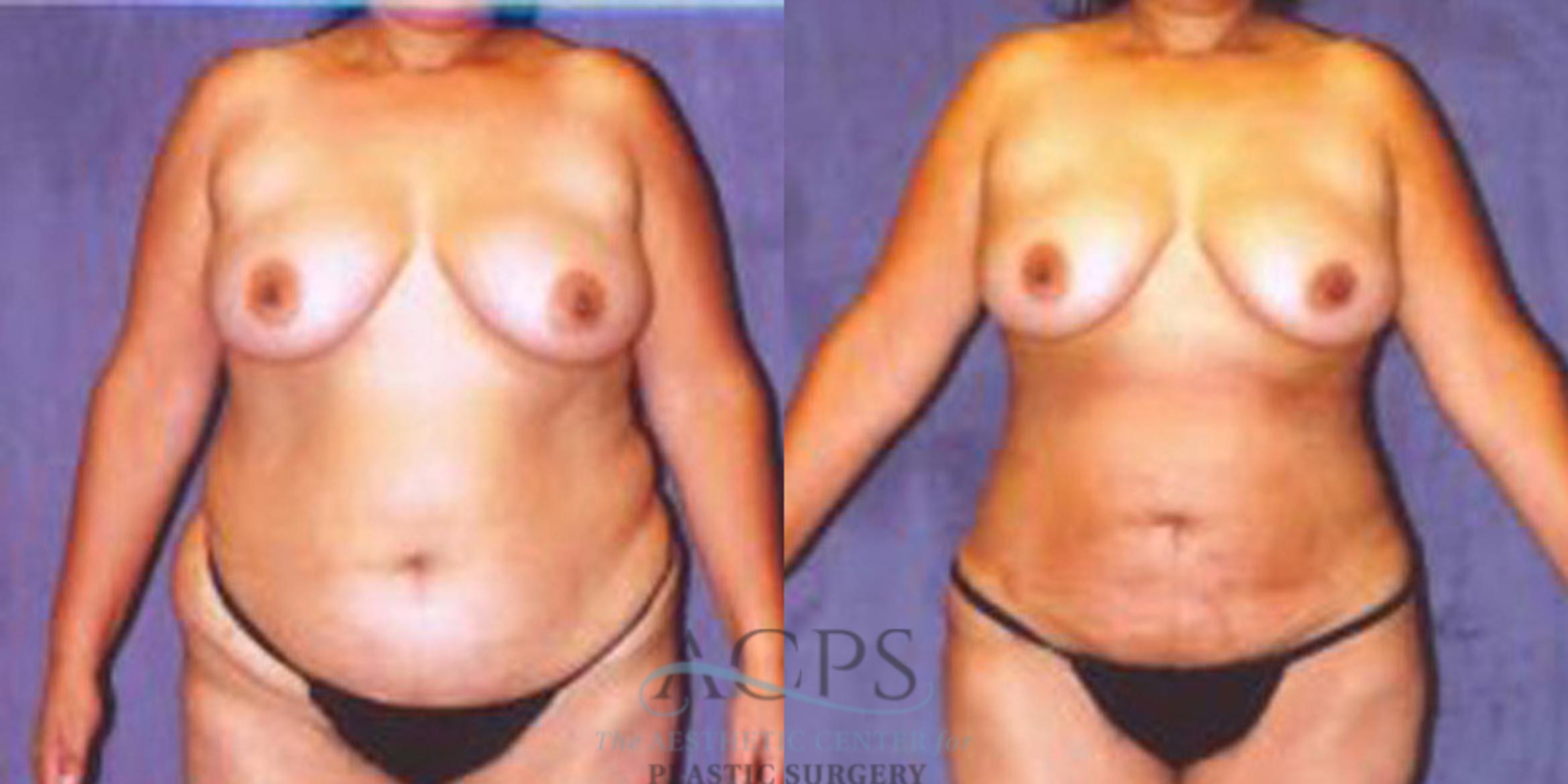 Before & After Liposuction Case 244 Front View: View in Houston, TX