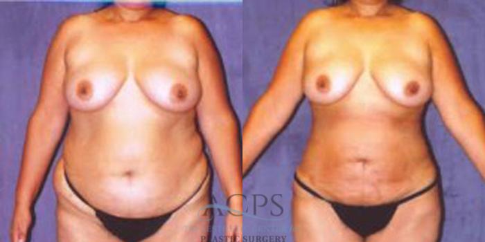 Before & After Liposuction Case 244 Front View: View in Houston, TX