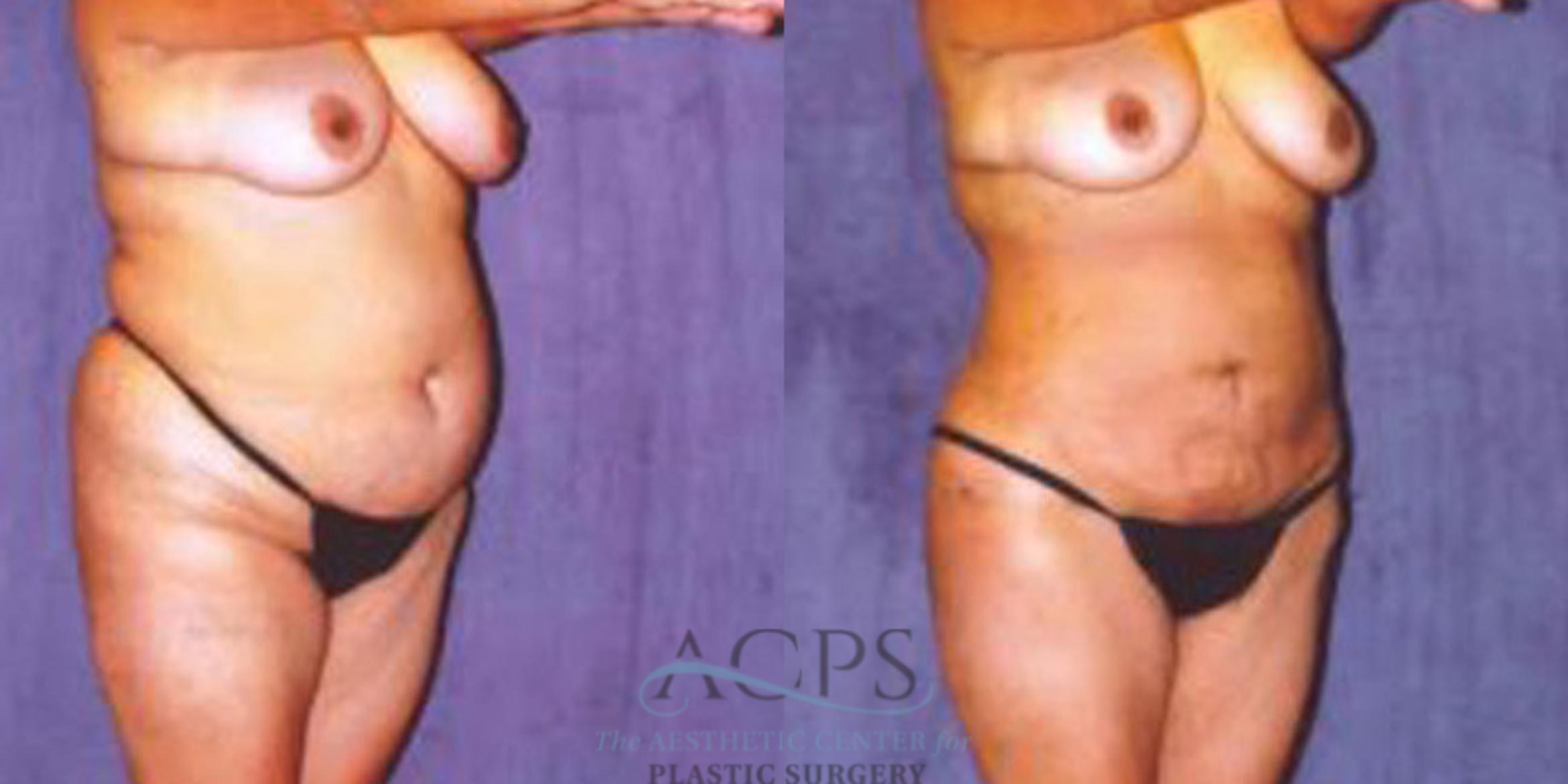 Before & After Liposuction Case 244 Oblique View: View in Houston, TX