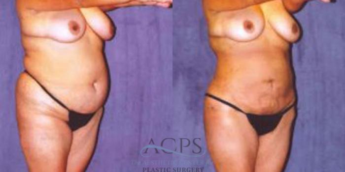 Before & After Liposuction Case 244 Oblique View: View in Houston, TX
