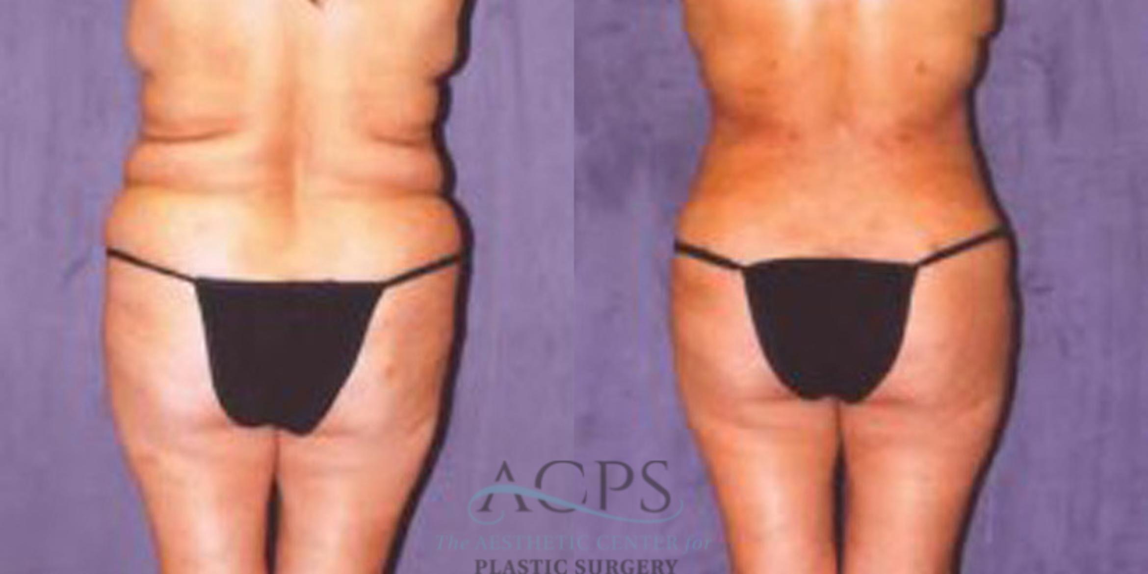 Before & After Liposuction Case 244 Rear View: View in Houston, TX